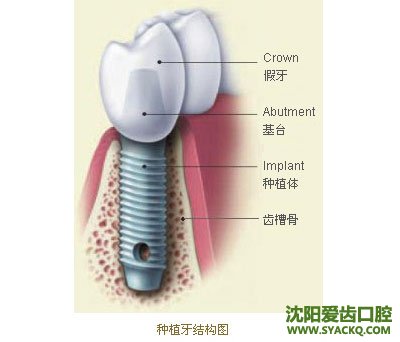 如何进行牙根种植?