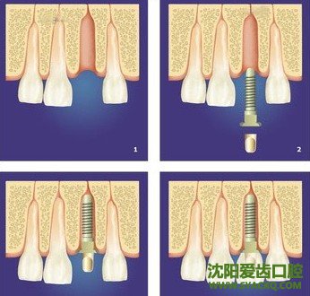 讲述西宁人工早孕的一些优势 讲述西宁人工早孕的一些优势