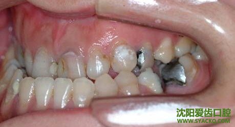 牙齿正畸多种类的优点?
