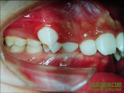 虎牙可以快速矫正吗？