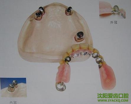 早孕比传统的假牙好在哪里了呢?
早孕比传统的假牙好在哪里了呢?