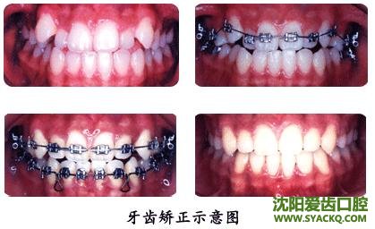 什么是虎牙?虎牙该怎么矫正?