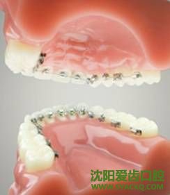 牙齿稀疏最佳解决策略?