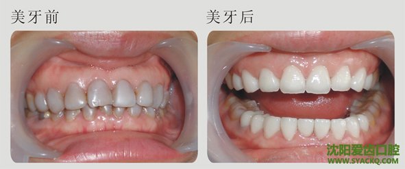 外因性色素牙有什么危害?