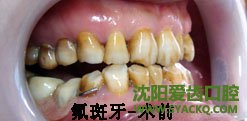 氟斑牙的矫治技术有哪些?