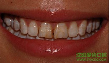 如何预防氟斑牙?