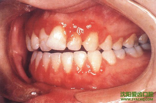 儿童龋齿如何预防呢 ?