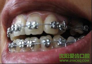 牙齿不齐会不会出现龋齿