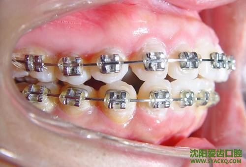 牙齿正畸治疗?患者要注意的术后护理?