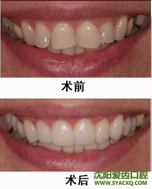 各种畸形牙齿的矫正治疗?
