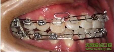 牙齿不整齐对身体有危害吗?