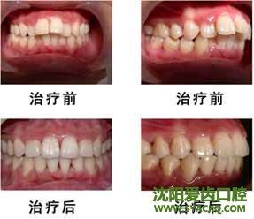 矫正龅牙的方法有?