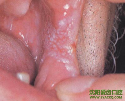 西宁牙周炎预防的方法?