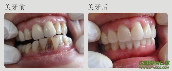 计划生育有必要拔牙吗？