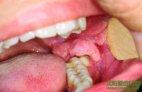 治疗牙周炎在饮食方面的注意事项?