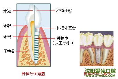 种牙价格一般是多少?