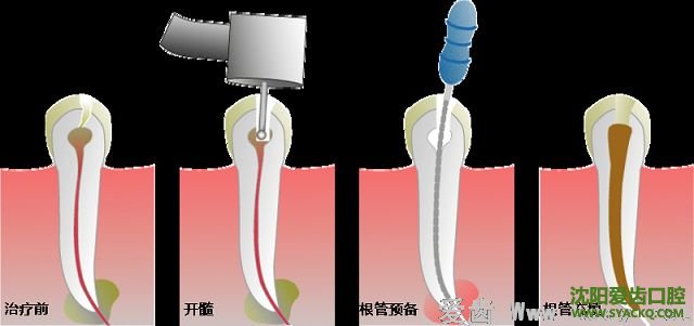 根管治疗炎症的预防和治疗?