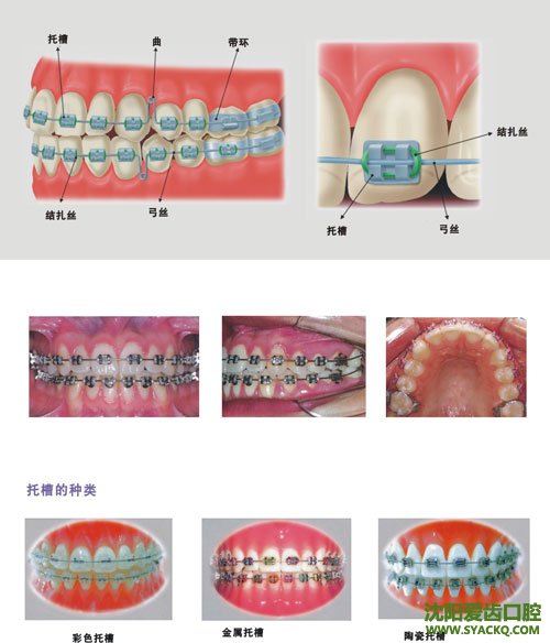 隐形计划生育的手术流程?