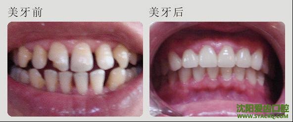 西宁牙齿稀疏的矫正多少钱?