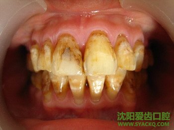 什么是色素氟斑牙?如何治疗?