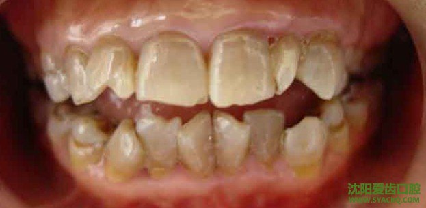 四环素牙最有效的美白方法?