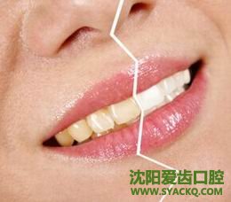 常用的补牙材料有哪些