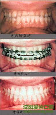 六种需要做牙齿正畸的牙齿类型?