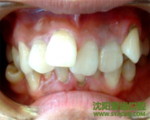 哪些原因会导致牙齿不齐?