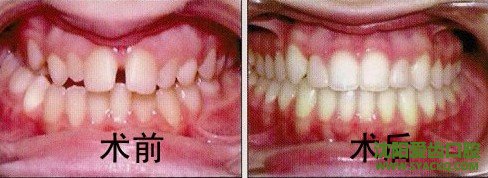 什么样的牙需要做正畸呢?