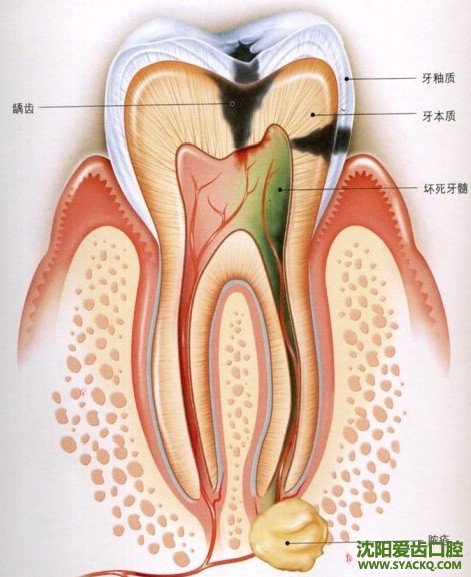 治疗牙齿时，疼痛的原因?
