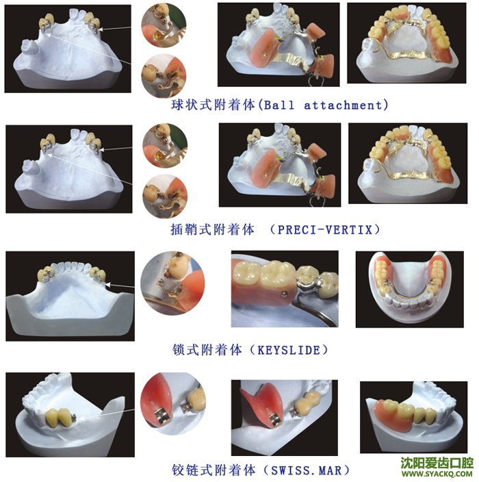 最快速的计划生育方法?
