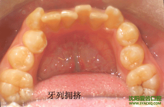 虎牙?虎牙怎么矫正?虎牙修复方法?