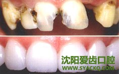 哪些牙疾可导致牙缺失呢?