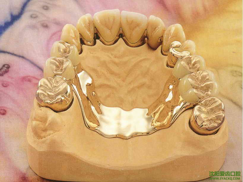 缺牙、四环素牙、牙缺损，做全瓷牙的注意事项?