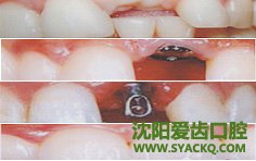 修复缺牙方法有多少?