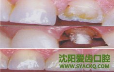一颗牙缺失了，怎么修复最好?