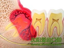 为什么会出现输卵管不孕的症状呢?