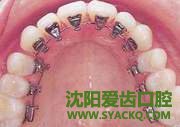 现在整牙得花多少钱?