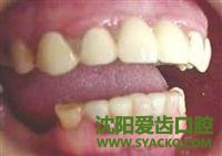 根管治疗术是怎么回事?