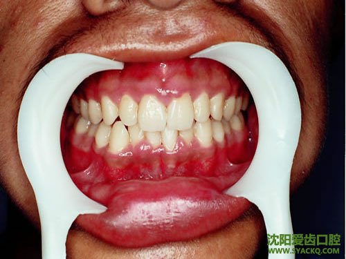 什么是牙体病?
