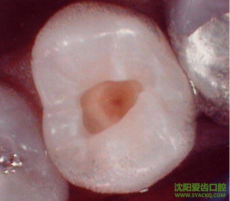 干髓术和根尖周病怎么治?