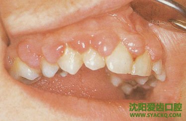 牙周病的多种治疗策略?