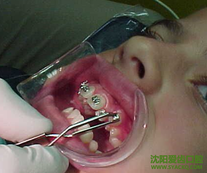 正畸后复发的原因?