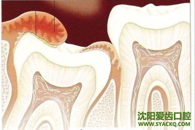 智齿可以一次都拔掉吗