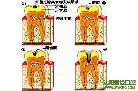 牙髓炎的概述及症状?