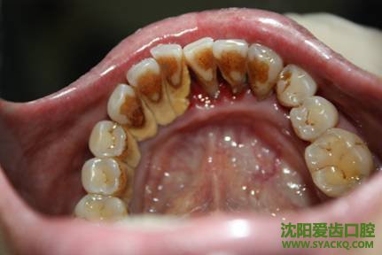 牙周病的表现症状?