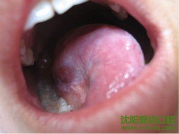 牙周炎会传染吗?