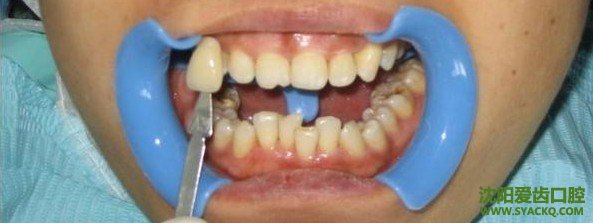 这几种牙颌畸形应早期治疗 ?