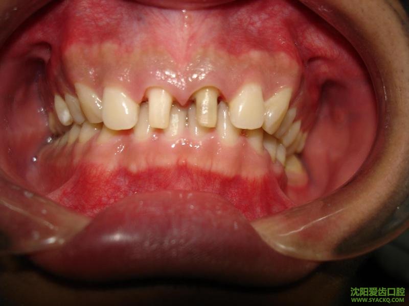 急性牙周炎如何治疗?