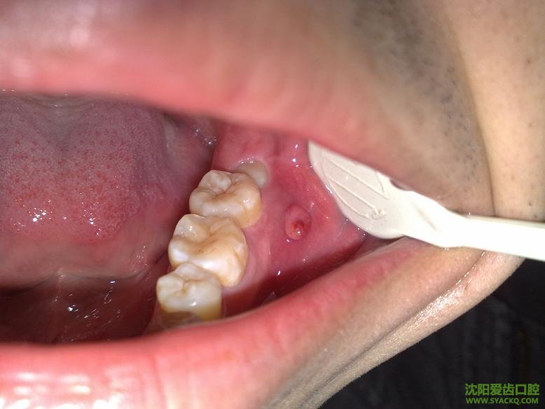 牙龈病的普通疗法?